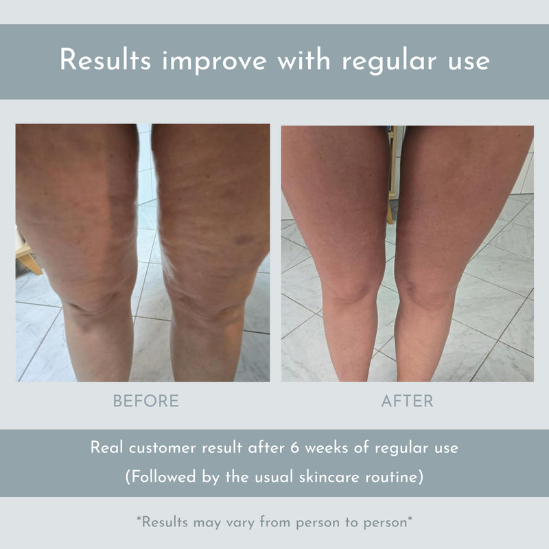 Before And After Stubborn Cellulite On Thighs Fitness Back Thigh Fat Exercises Workout To Get Rid Of Cellulite